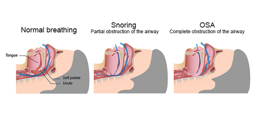 Cpap Fio2 Osa How CPAP Works