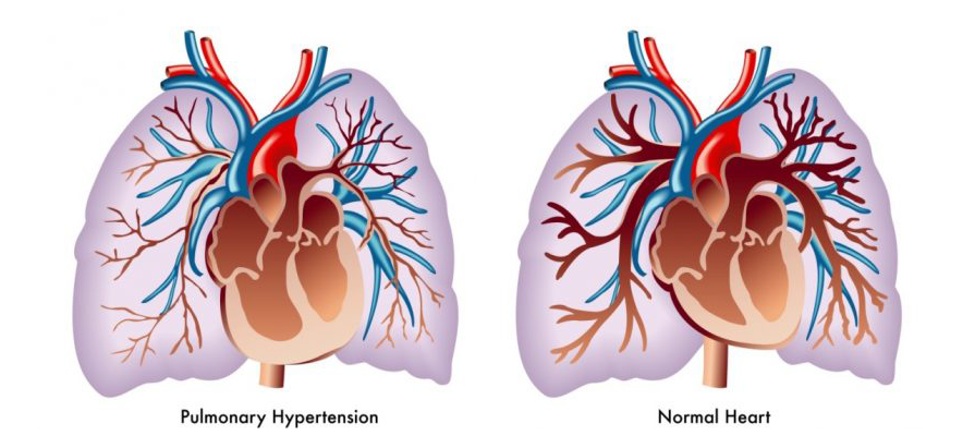 Sleep Apnoea and Pulmonary Hypertension
