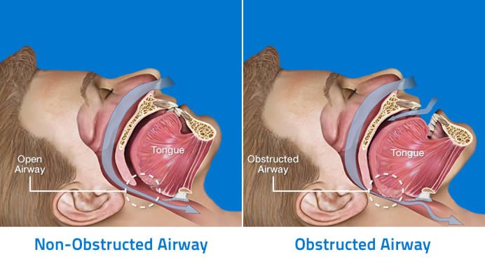 Sleep Apnoea Long Term Prognosis CPAP Victoria